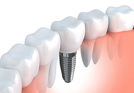 Odontologia Implante Dentário