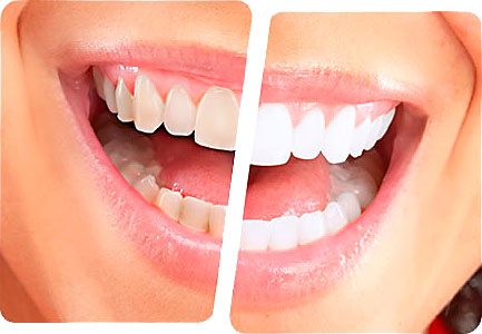 Odontologia Clareamento dentes boca