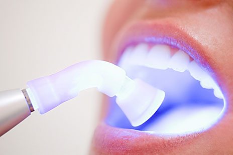 Odontologia Clareamento dentes laser