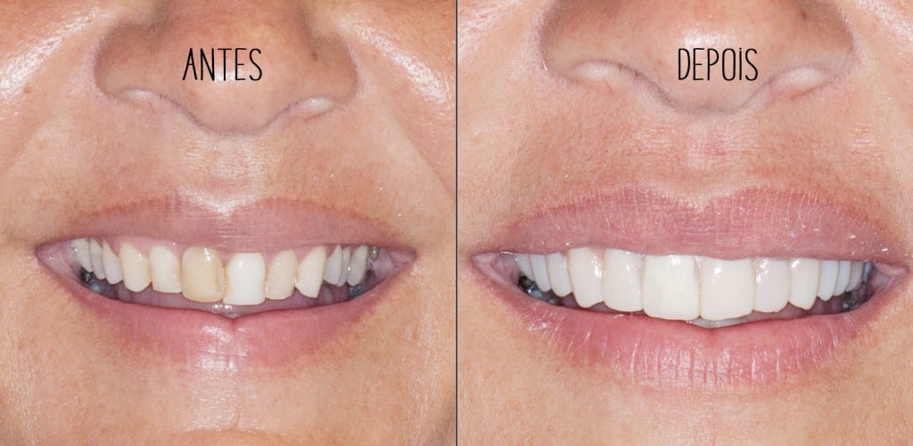 antesdepois dentes
