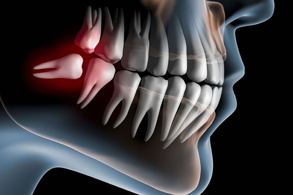 dente siso