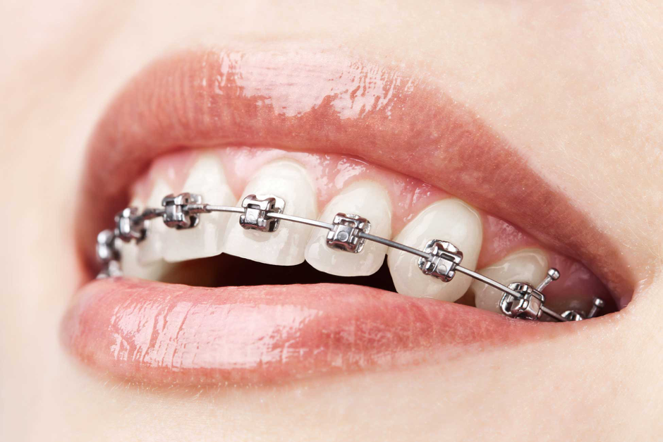O modelo dispensa os elásticos para prender os fios nos brackets.