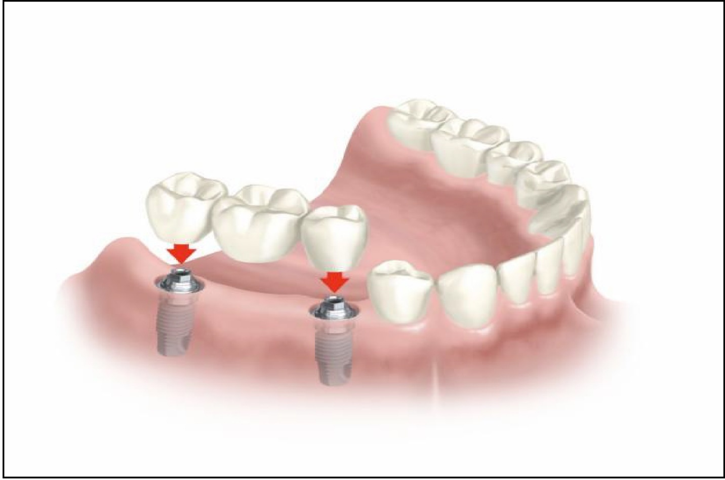 Implantes dentários: mitos e verdades - Instituto Barbosa de Odontologia