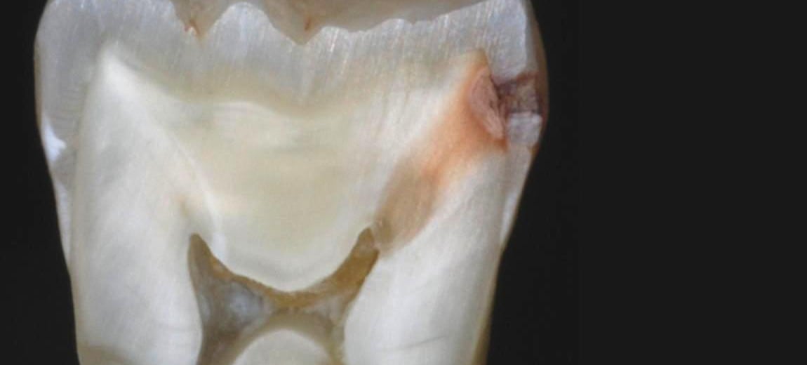Dente siso quebrado: quais as complicações e como tratar?