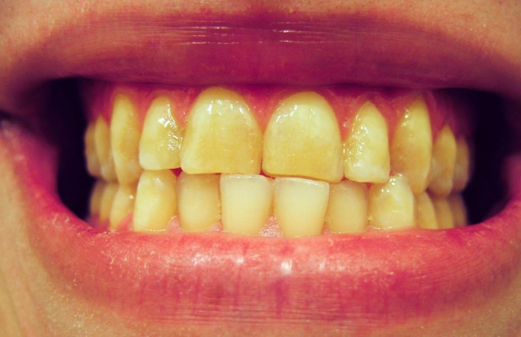 A exposição da dentina é a responsável pelo tom amarelado dos dentes.
