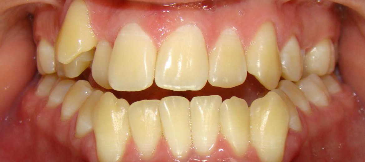 Featured image of post Dente Entramelado O Que Fazer As vezes o tratamento endodontico pode sair mais caro do que a exodontia