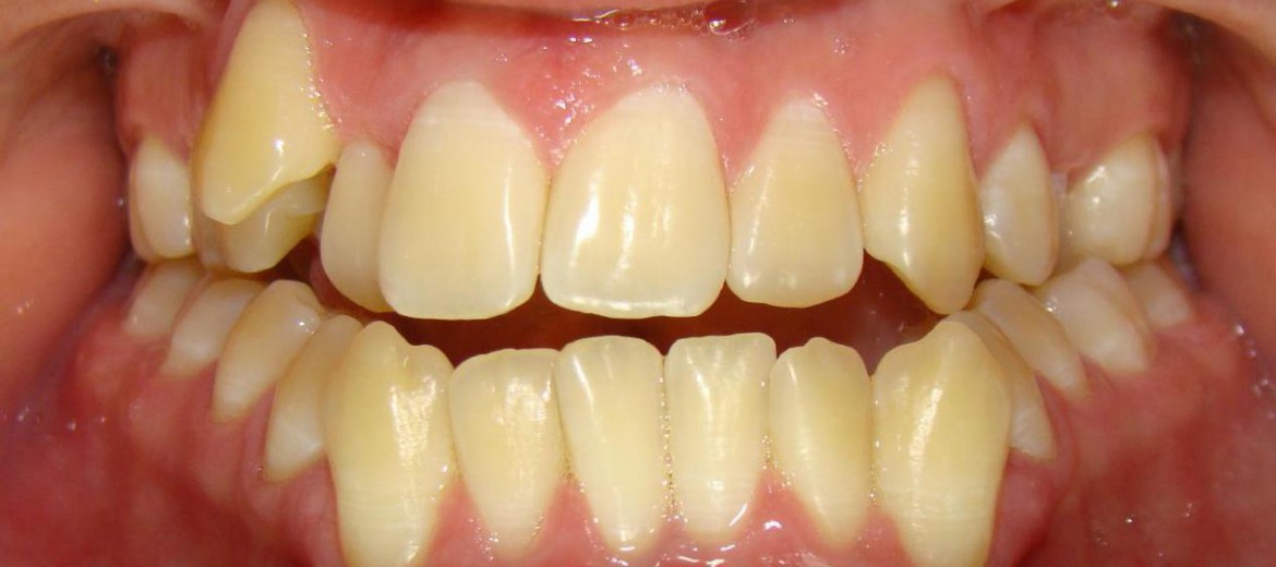 Featured image of post Dente Entramelado O Que Fazer O que pode fazer e o que n o pode durante a gravidez e os tratamentos dent rios