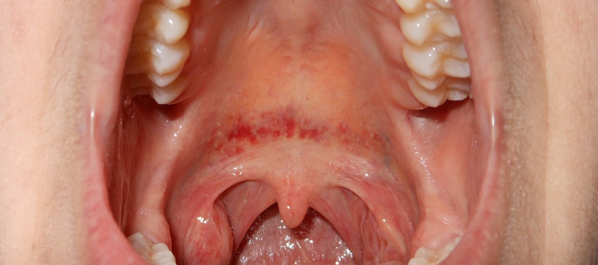 Featured image of post Imagens De Afta No Céu Da Boca / As aftas são feridas bucais, pequenas úlceras que podem aparecer dentro da boca por vários motivos, causando desconforto e dor intensa.