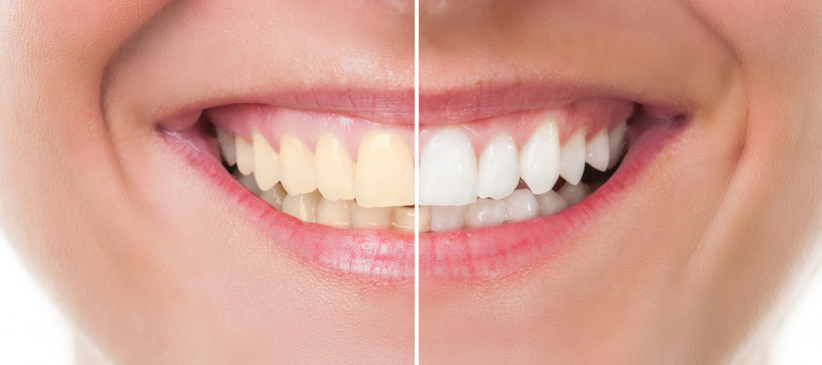 dicas-manter-restaurar-esmalte-dentes