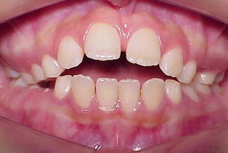 aberta anterior