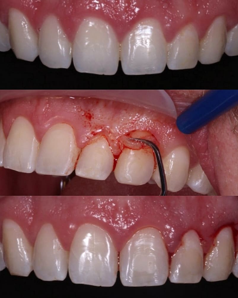 gengivoplastia